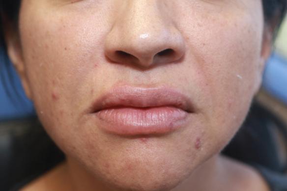 Lip enlargement and augmentation with Juvederm Ultra XC after photo